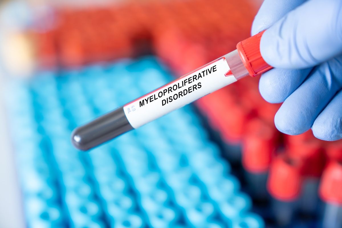 Multi-Hit TP53 Linked to Shorter Survival in Chronic-Phase MPN Cohorts