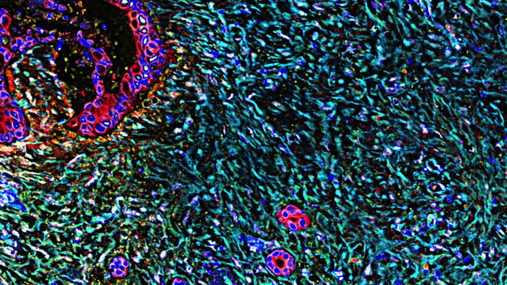 Revolution Medicines’ Pancreatic Cancer Drug Draws Early Expansion Buzz