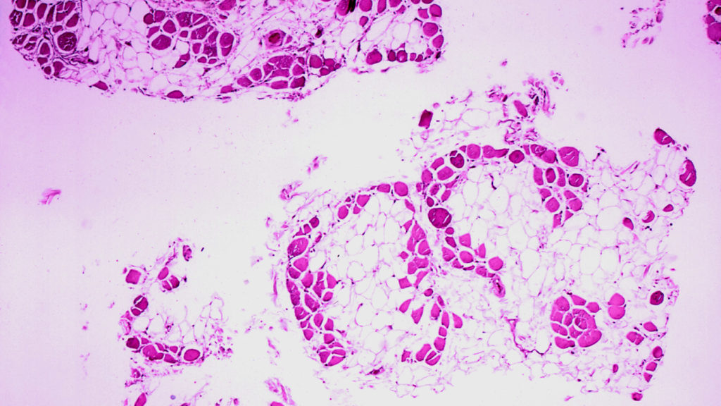 STAT+: FDA expert committee reviews Capricor Therapeutics' Duchenne drug