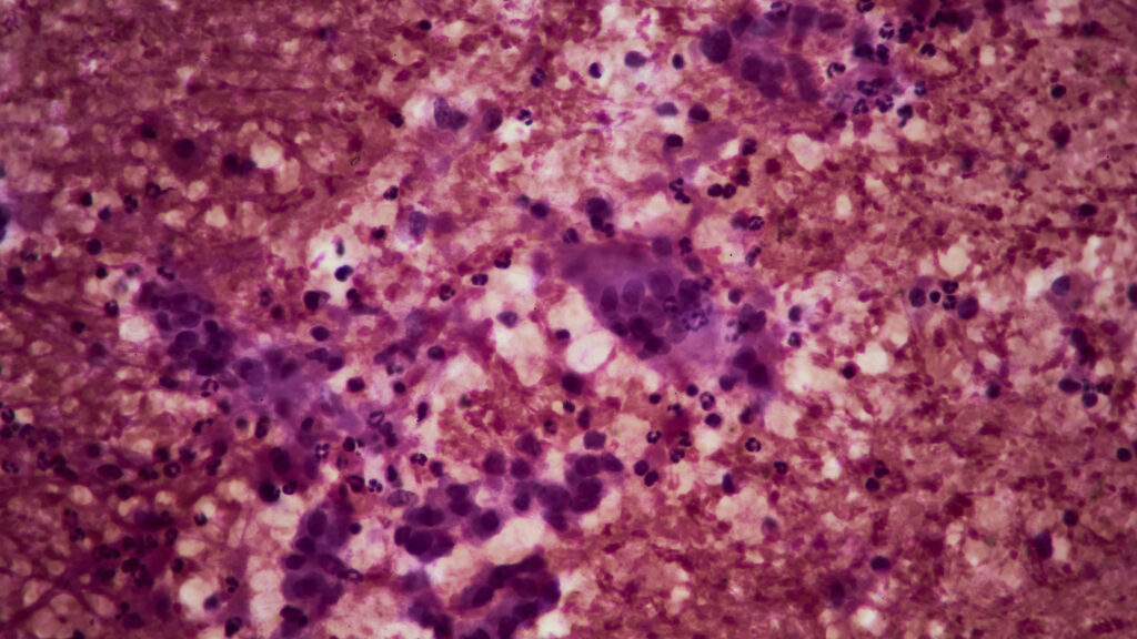 STAT+: Tango reports 82% tumor response rate in trial of combo therapy for advanced pancreatic cancer