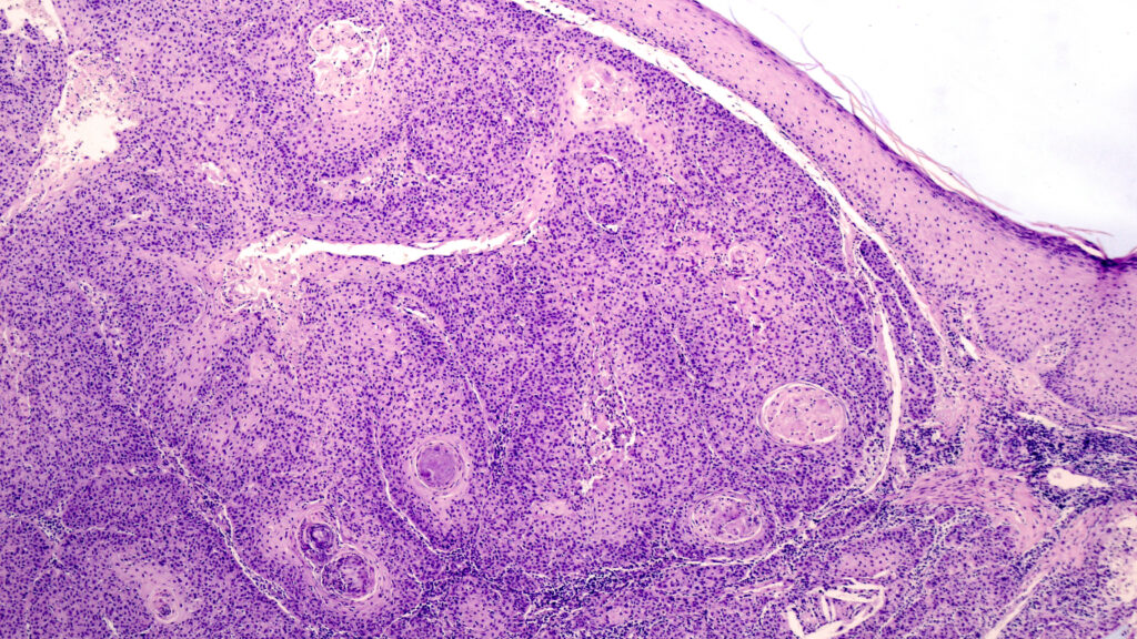 STAT+: Tracking the FDA expert review of Replimune's melanoma treatment